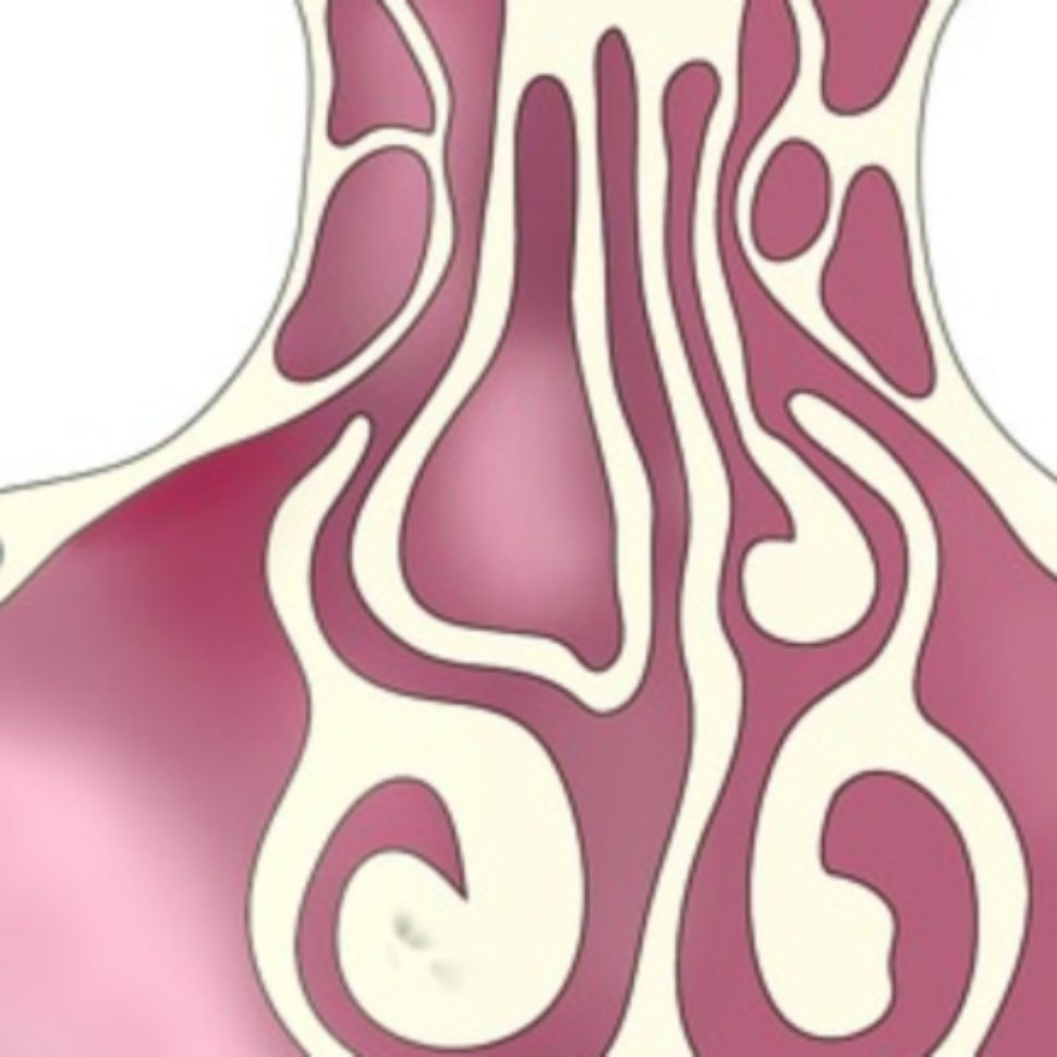 Хирургическое лечение буллезной раковины
